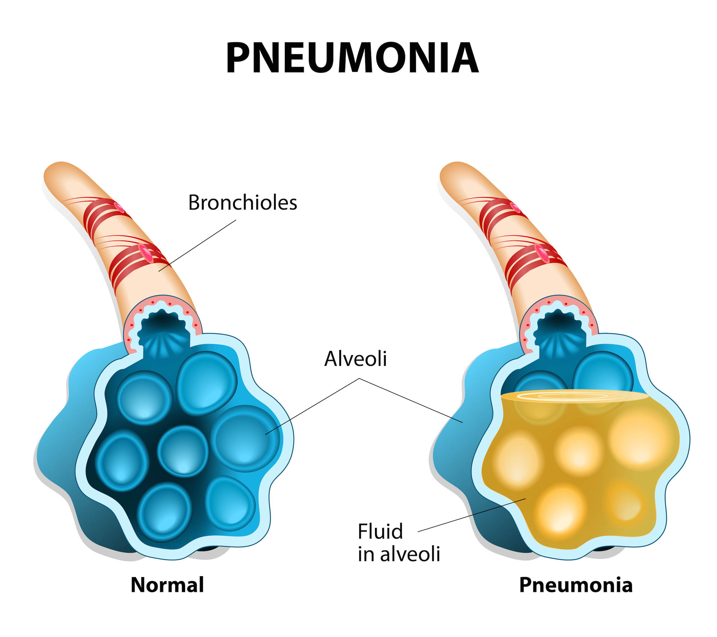pneumonia resized.jpg